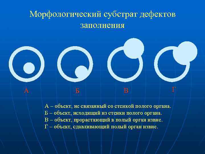 Морфологический субстрат дефектов заполнения А Б В А – объект, не связанный со стенкой