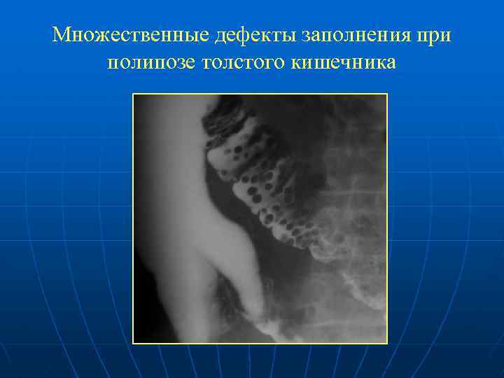 Множественные дефекты заполнения при полипозе толстого кишечника 