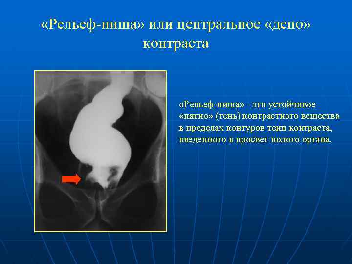  «Рельеф-ниша» или центральное «депо» контраста «Рельеф-ниша» - это устойчивое «пятно» (тень) контрастного вещества