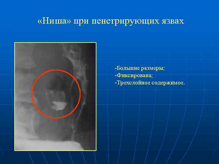 «Ниша» при пенетрирующих язвах -Большие размеры; -Фиксирована; -Трехслойное содержимое. 