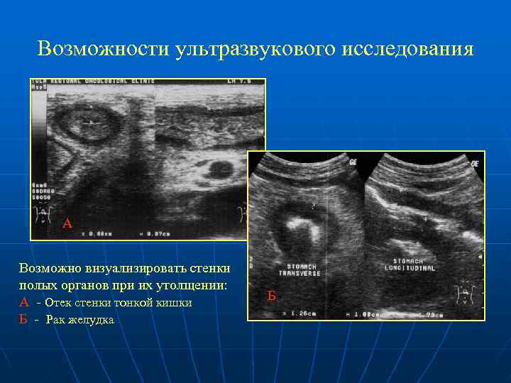 Возможности ультразвукового исследования А Возможно визуализировать стенки полых органов при их утолщении: А -
