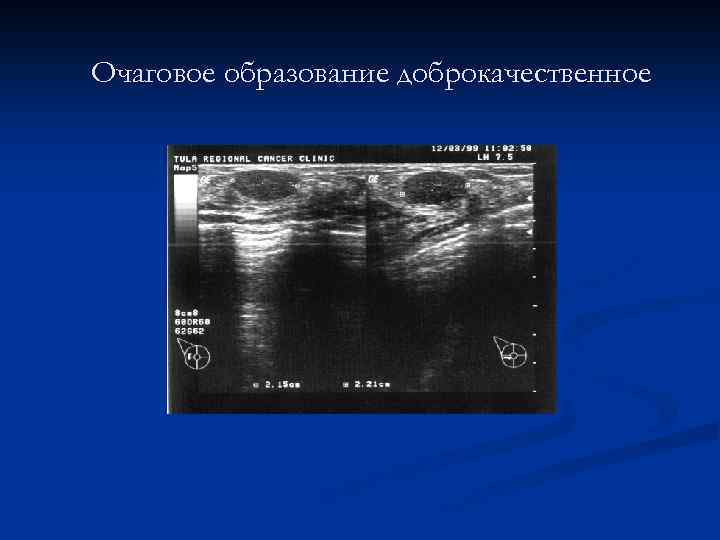 Лучевая диагностика заболеваний молочных желез презентация