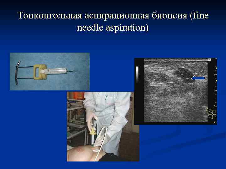 Тонкоигольная аспирационная биопсия (fine needle aspiration) 