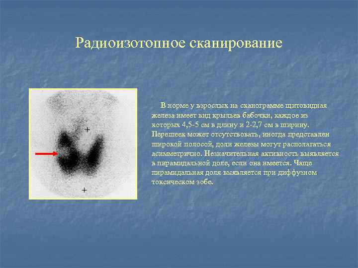 Лучевая железа. Радиоизотопное сканирование щитовидной железы. Методы лучевого исследования щитовидной железы. Сцинтиграфия щитовидной железы патологии. Сканограмма щитовидной железы в норме.