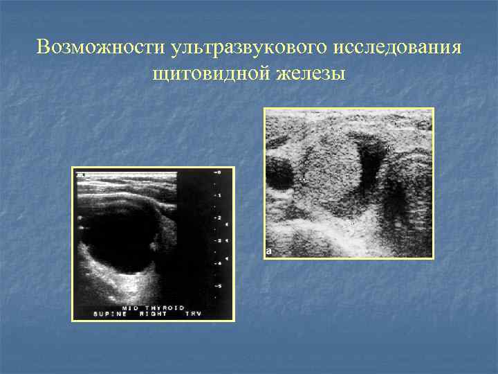 Возможности ультразвукового исследования щитовидной железы 
