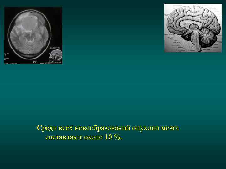Среди всех новообразований опухоли мозга составляют около 10 %. 