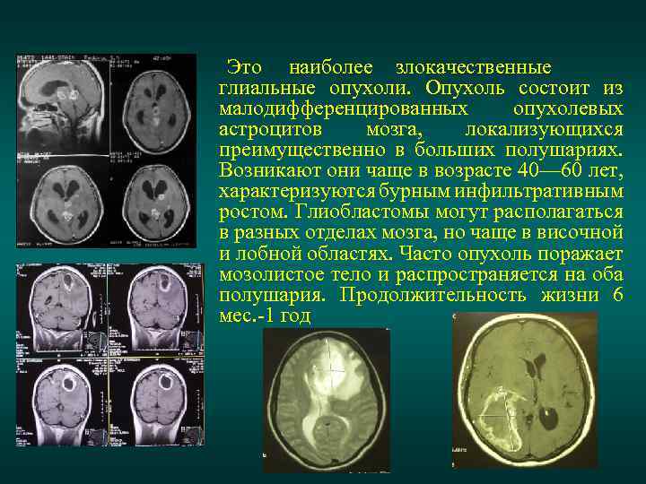 Это наиболее злокачественные глиальные опухоли. Опухоль состоит из малодифференцированных опухолевых астроцитов мозга, локализующихся преимущественно