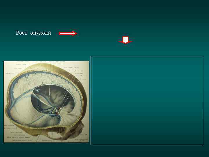 Рост опухоли 