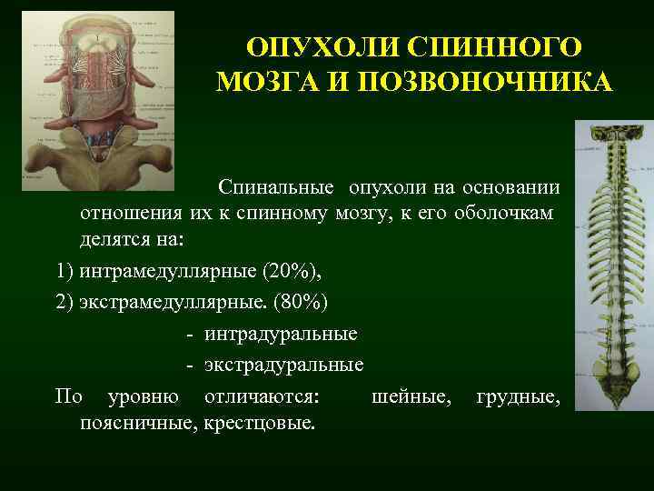 Опухоль спинного мозга. Экстрадуральные опухоли спинного мозга. Экстрадуральные экстрамедуллярные опухоли спинного мозга. Интрамедуллярная опухоль спинного мозга. Экстрамедуллярное образование спинного мозга.