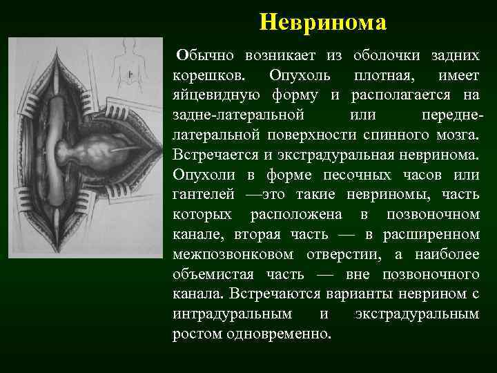 Невринома Обычно возникает из оболочки задних корешков. Опухоль плотная, имеет яйцевидную форму и располагается