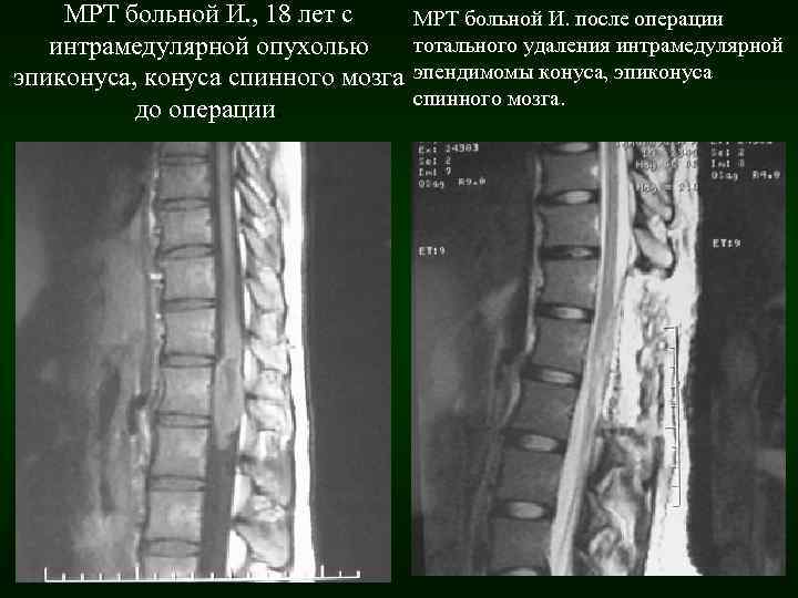 МРТ больной И. , 18 лет с интрамедулярной опухолью эпиконуса, конуса спинного мозга до