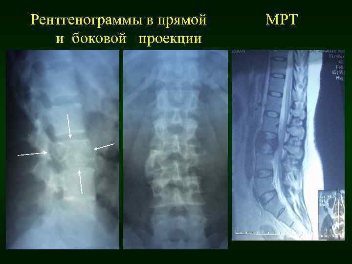 Рентгенограммы в прямой и боковой проекции МРТ 