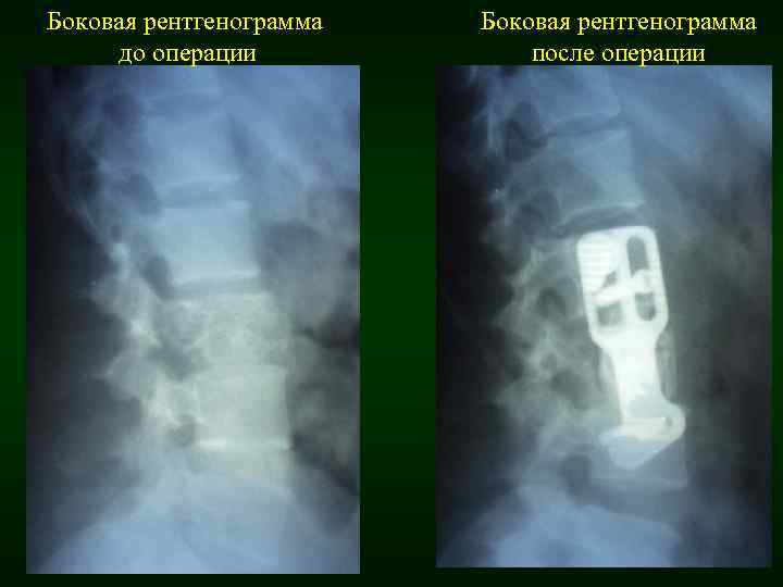 Боковая рентгенограмма до операции Боковая рентгенограмма после операции 