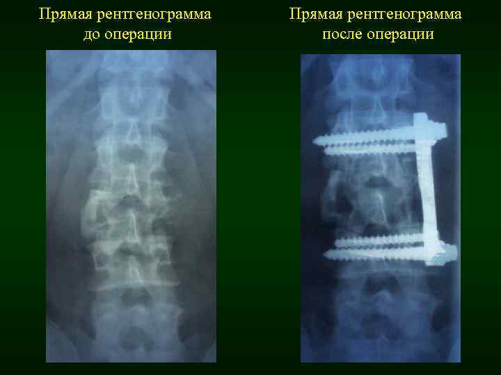 Прямая рентгенограмма до операции Прямая рентгенограмма после операции 