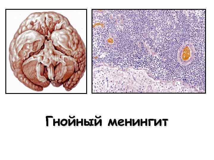 Гнойный менингит 