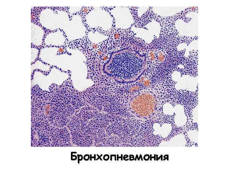 Пневмония микропрепарат описание. Осаговая пгевмония микро. Бронхопневмония патанатомия макропрепарат. Очаговая пневмония микропрепарат. Гнойная пневмония гистология.