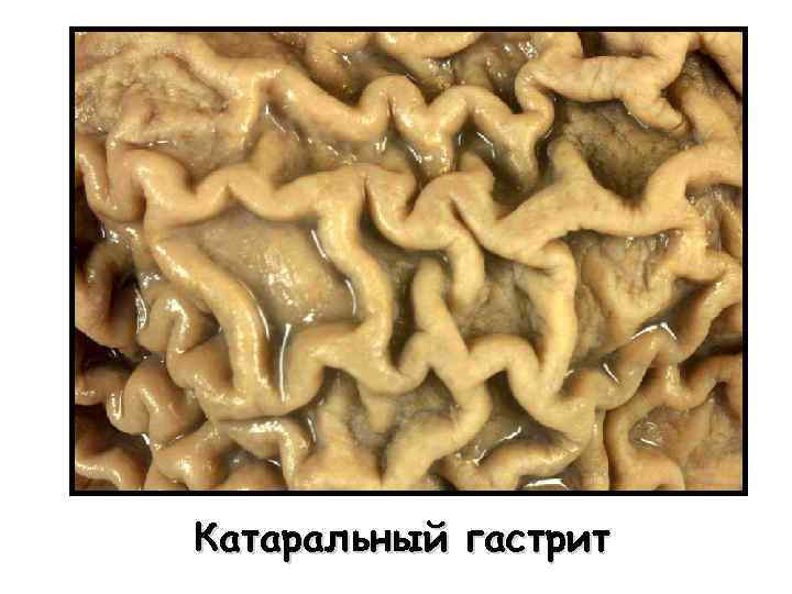 Катаральный гастрит 