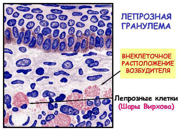 ЛЕПРОЗНАЯ ГРАНУЛЕМА ВНЕКЛЕТОЧНОЕ РАСПОЛОЖЕНИЕ ВОЗБУДИТЕЛЯ Лепрозные клетки (Шары Вирхова) 