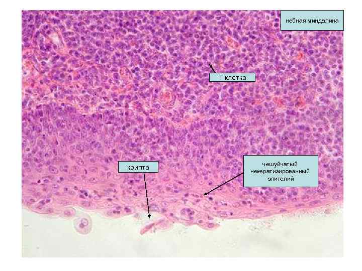 небная миндалина Т клетка крипта чешуйчатый некератизированный эпителий 