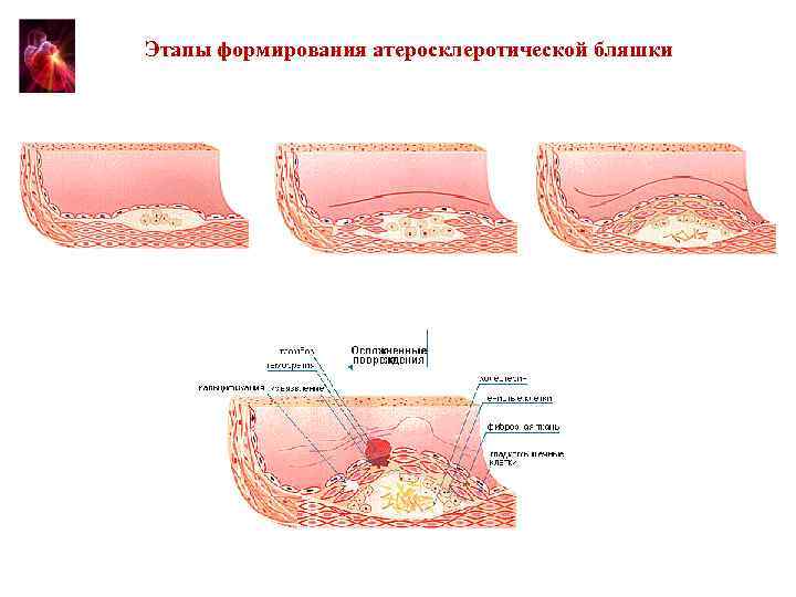 Этапы формирования атеросклеротической бляшки 