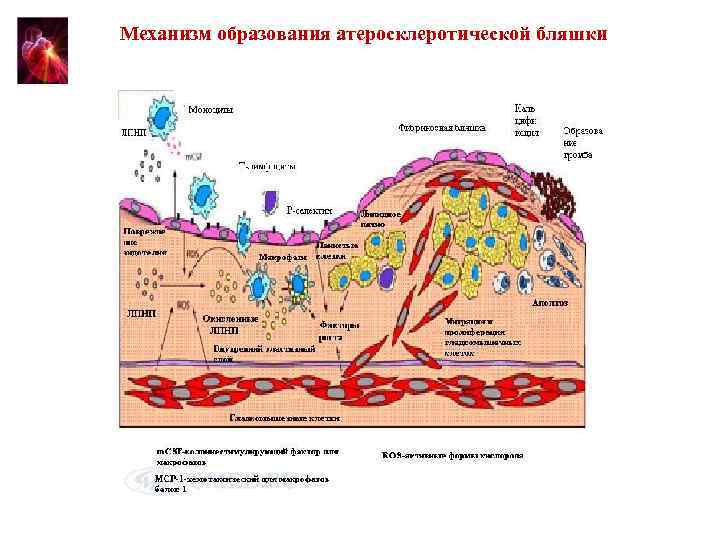 Морфологическая картина атеросклероза стабильная и нестабильная атеросклеротическая бляшка