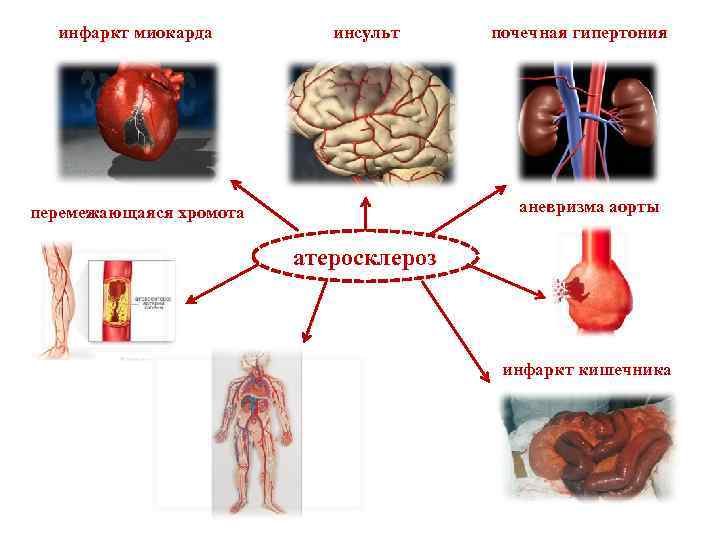 инфаркт миокарда инсульт почечная гипертония аневризма аорты перемежающаяся хромота атеросклероз инфаркт кишечника 
