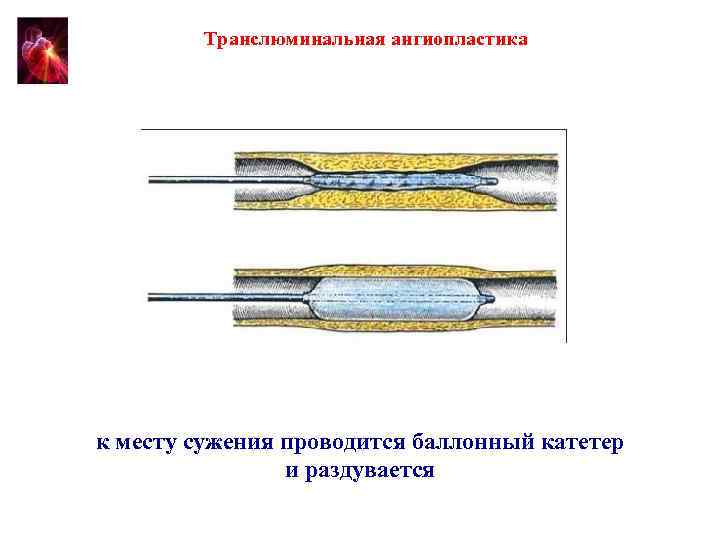 Баллонная ангиопластика артерий. ТРАНСЛЮМИНАЛЬНАЯ ангиопластика. ТРАНСЛЮМИНАЛЬНАЯ баллонная дилатация. ТРАНСЛЮМИНАЛЬНАЯ баллонная ангиопластика и стентирование.