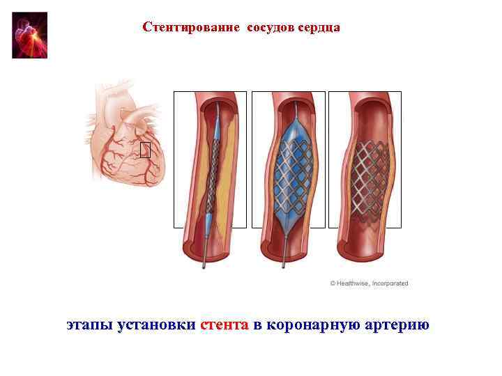 Стентирование сосудов сердца этапы установки стента в коронарную артерию 