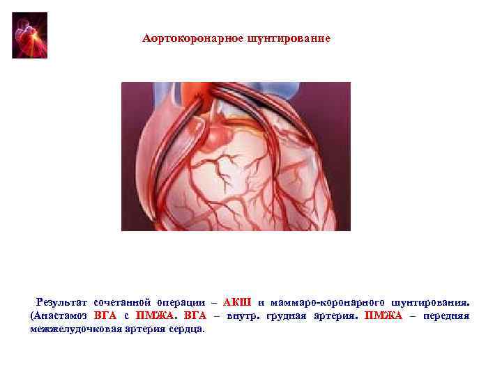 Аортокоронарное шунтирование Результат сочетанной операции – АКШ и маммаро-коронарного шунтирования. (Анастамоз ВГА с ПМЖА.