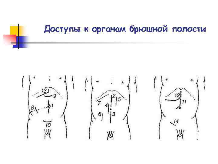 Доступы к органам брюшной полости 