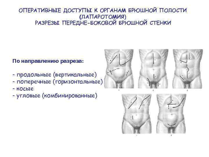 ОПЕРАТИВНЫЕ ДОСТУПЫ К ОРГАНАМ БРЮШНОЙ ПОЛОСТИ (ЛАПАРОТОМИЯ) РАЗРЕЗЫ ПЕРЕДНЕ-БОКОВОЙ БРЮШНОЙ СТЕНКИ По направлению разреза: