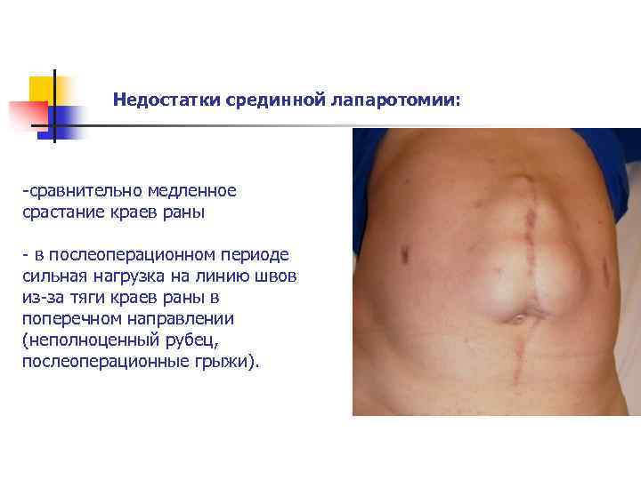Недостатки срединной лапаротомии: -сравнительно медленное срастание краев раны - в послеоперационном периоде сильная нагрузка