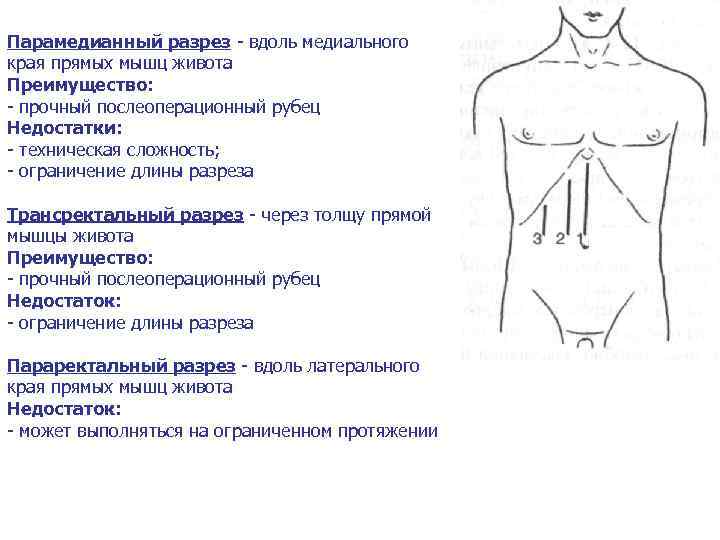 Парамедианный разрез - вдоль медиального края прямых мышц живота Преимущество: - прочный послеоперационный рубец
