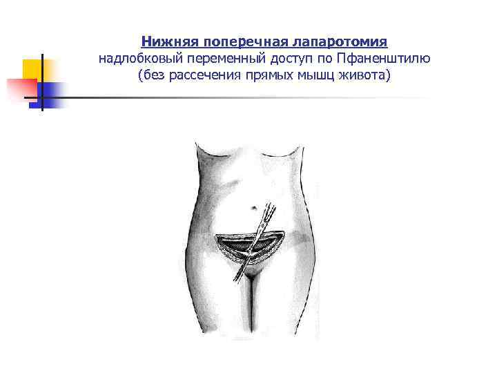 Нижняя поперечная лапаротомия надлобковый переменный доступ по Пфаненштилю (без рассечения прямых мышц живота) 
