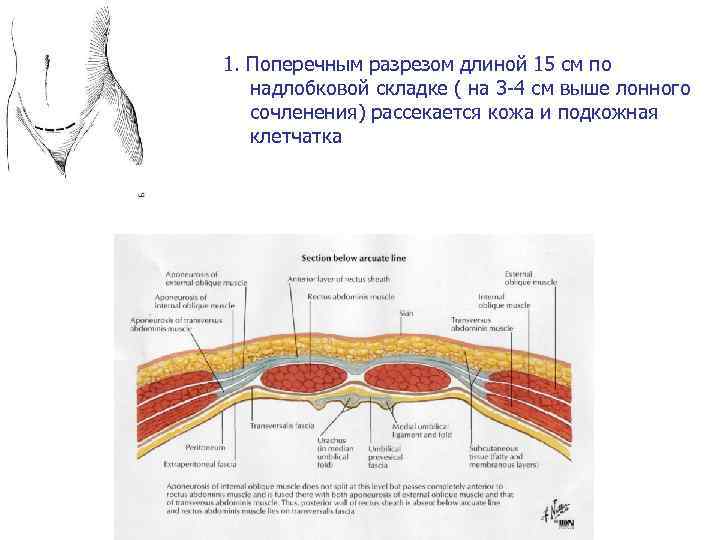 1. Поперечным разрезом длиной 15 см по надлобковой складке ( на 3 -4 см