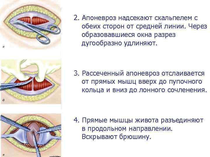 2. Апоневроз надсекают скальпелем с обеих сторон от средней линии. Через образовавшиеся окна разрез