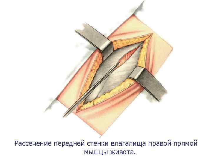 Рассечение передней стенки влагалища правой прямой мышцы живота. 