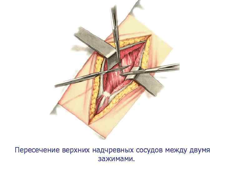 Пересечение верхних надчревных сосудов между двумя зажимами. 