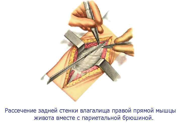 Рассечение задней стенки влагалища правой прямой мышцы живота вместе с париетальной брюшиной. 