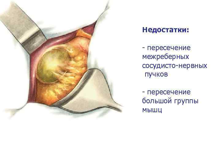 Недостатки: - пересечение межреберных сосудисто-нервных пучков - пересечение большой группы мышц 
