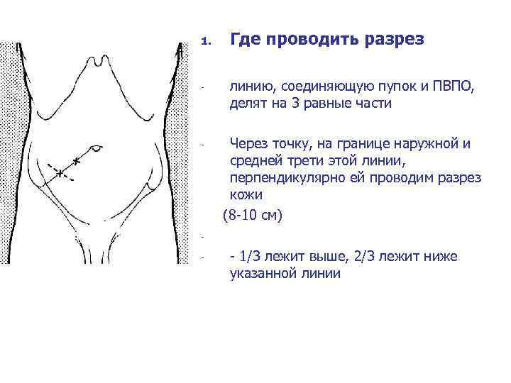 1. - Где проводить разрез линию, соединяющую пупок и ПВПО, делят на 3 равные