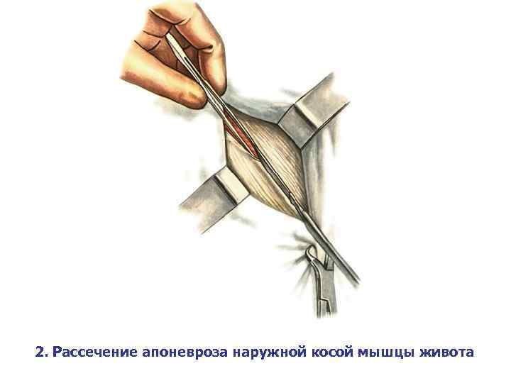 2. Рассечение апоневроза наружной косой мышцы живота 