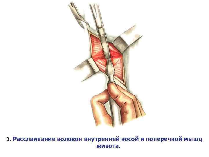 3. Расслаивание волокон внутренней косой и поперечной мышц живота. 