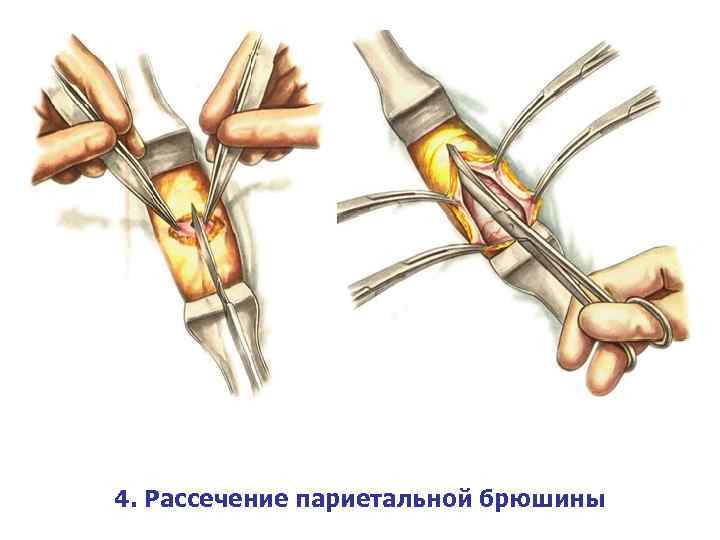 4. Рассечение париетальной брюшины 