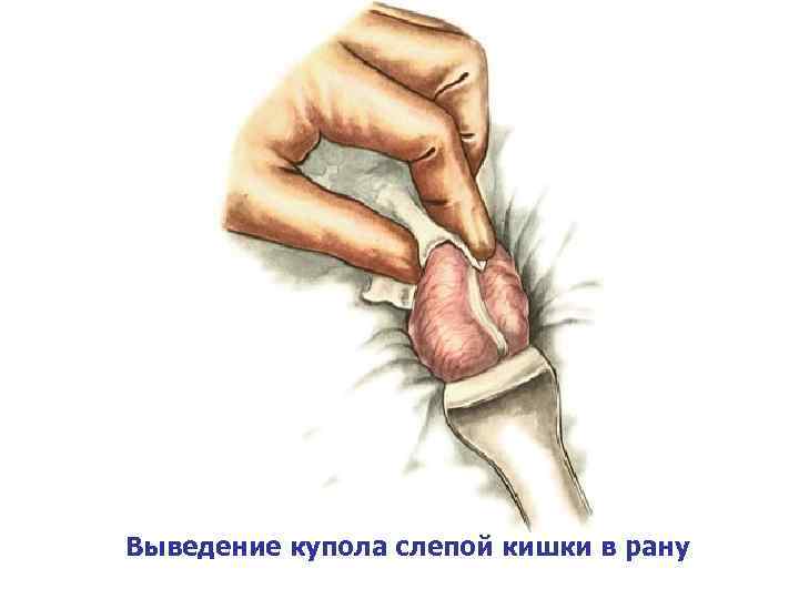 Выведение купола слепой кишки в рану 