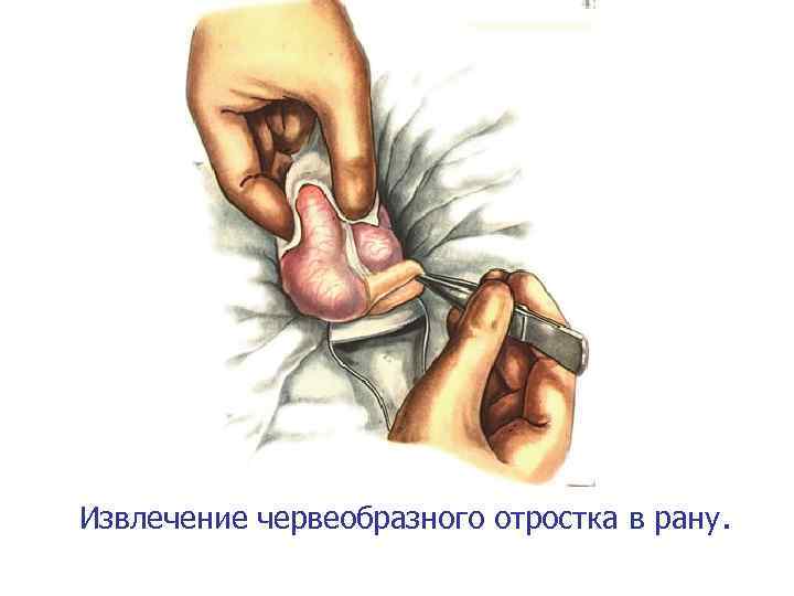 Извлечение червеобразного отростка в рану. 