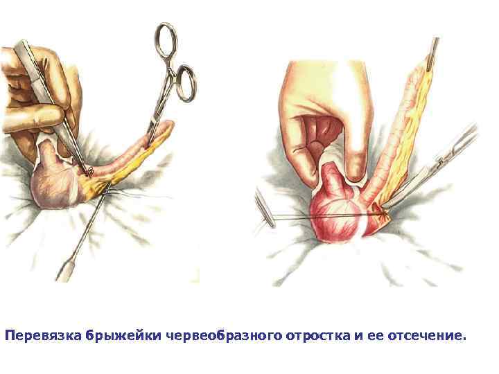 Перевязка брыжейки червеобразного отростка и ее отсечение. 