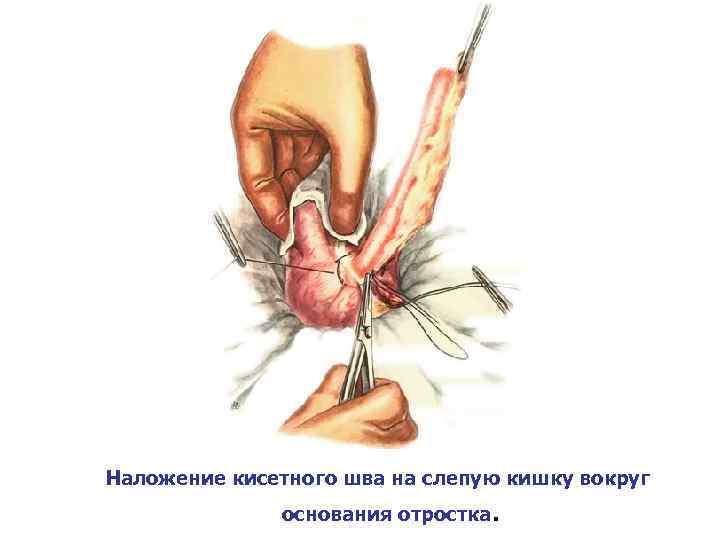 Наложение кисетного шва на слепую кишку вокруг основания отростка . 