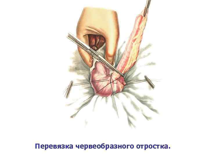 Перевязка червеобразного отростка. 