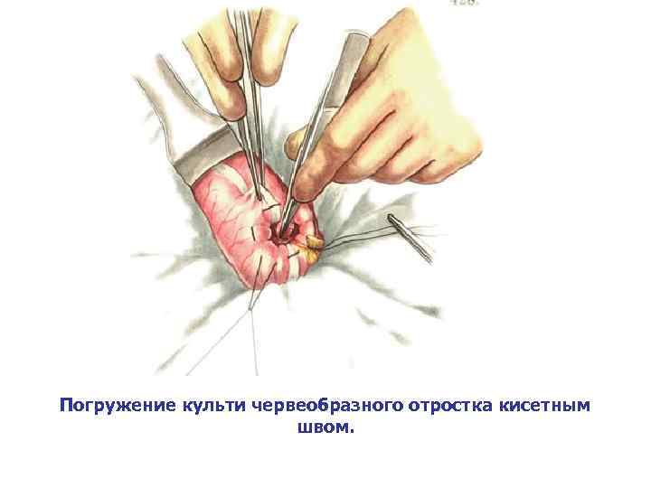 Погружение культи червеобразного отростка кисетным швом. 